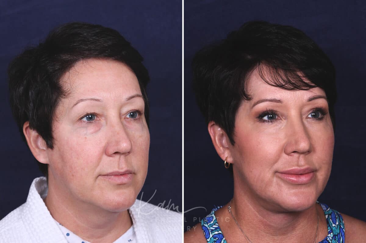 Facelift before and after photos in Voorhees, NJ, Patient 433