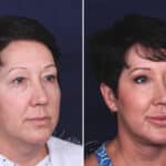 Facelift before and after photos in Voorhees, NJ, Patient 433
