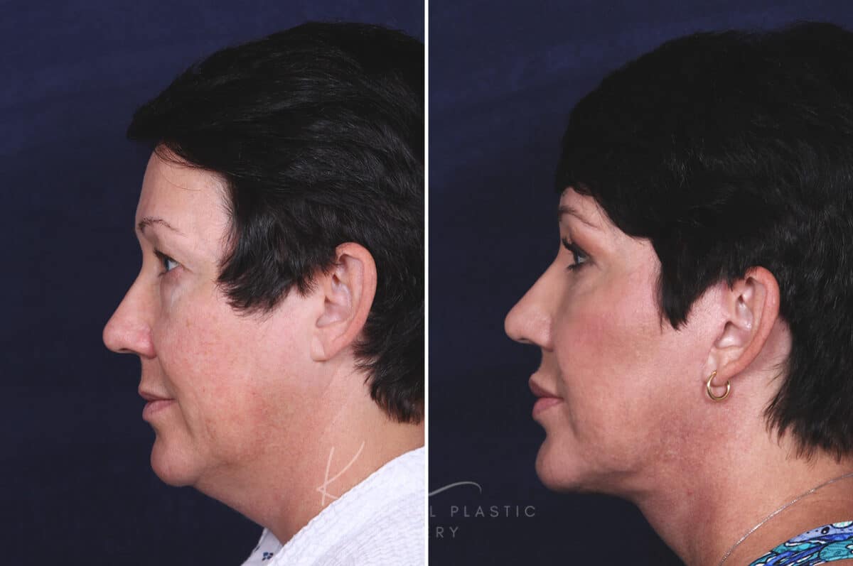 Facelift before and after photos in Voorhees, NJ, Patient 433