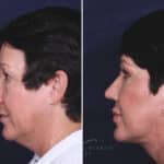 Facelift before and after photos in Voorhees, NJ, Patient 433