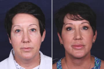 Facelift before and after photos in Voorhees, NJ, Patient 433