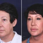 Facelift before and after photos in Voorhees, NJ, Patient 433