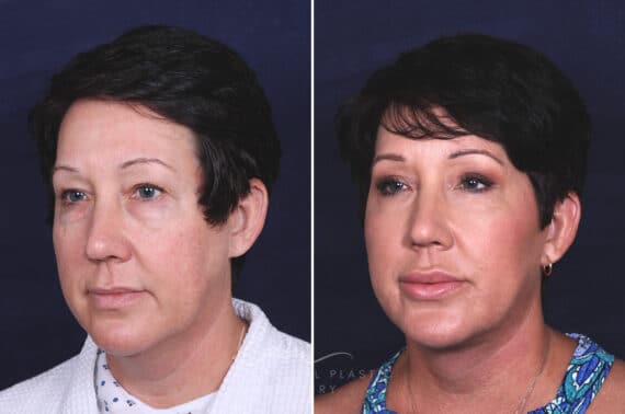 Facelift before and after photos in Voorhees, NJ, Patient 433