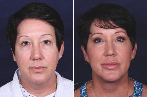 Facelift before and after photos in Voorhees, NJ, Patient 433