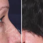 Lower Blepharoplasty before and after photos in Voorhees, NJ, Patient 465