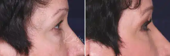 Lower Blepharoplasty before and after photos in Voorhees, NJ, Patient 465