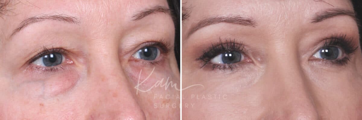 Lower Blepharoplasty before and after photos in Voorhees, NJ, Patient 465