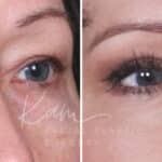 Lower Blepharoplasty before and after photos in Voorhees, NJ, Patient 465