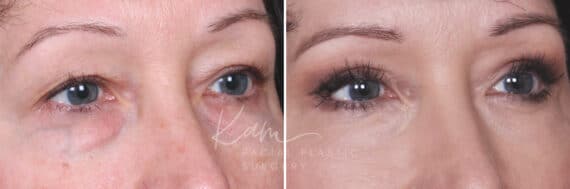 Lower Blepharoplasty before and after photos in Voorhees, NJ, Patient 465