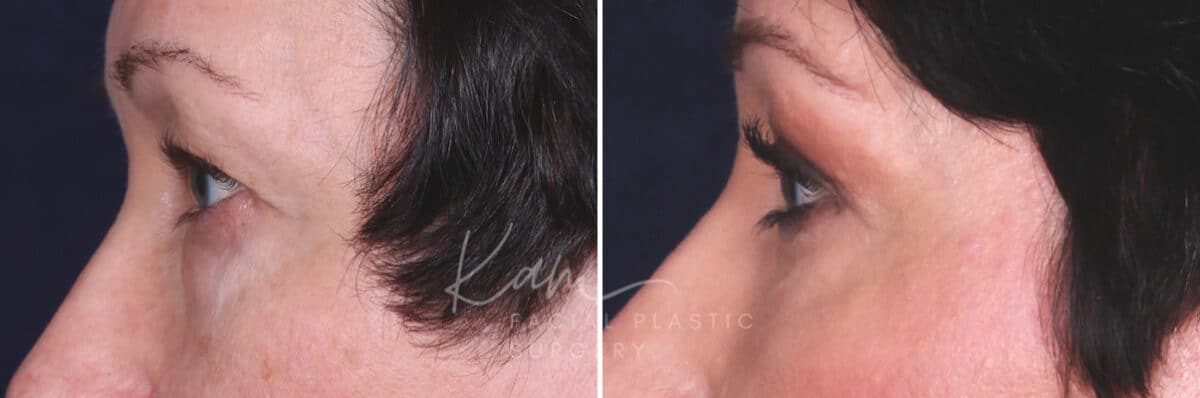 Lower Blepharoplasty before and after photos in Voorhees, NJ, Patient 465