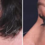 Lower Blepharoplasty before and after photos in Voorhees, NJ, Patient 465