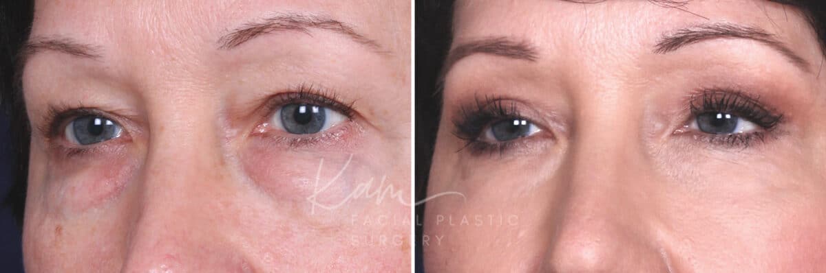 Lower Blepharoplasty before and after photos in Voorhees, NJ, Patient 465
