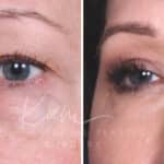 Lower Blepharoplasty before and after photos in Voorhees, NJ, Patient 465