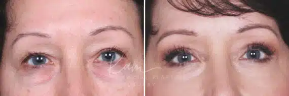 Lower Blepharoplasty before and after photos in Voorhees, NJ, Patient 465