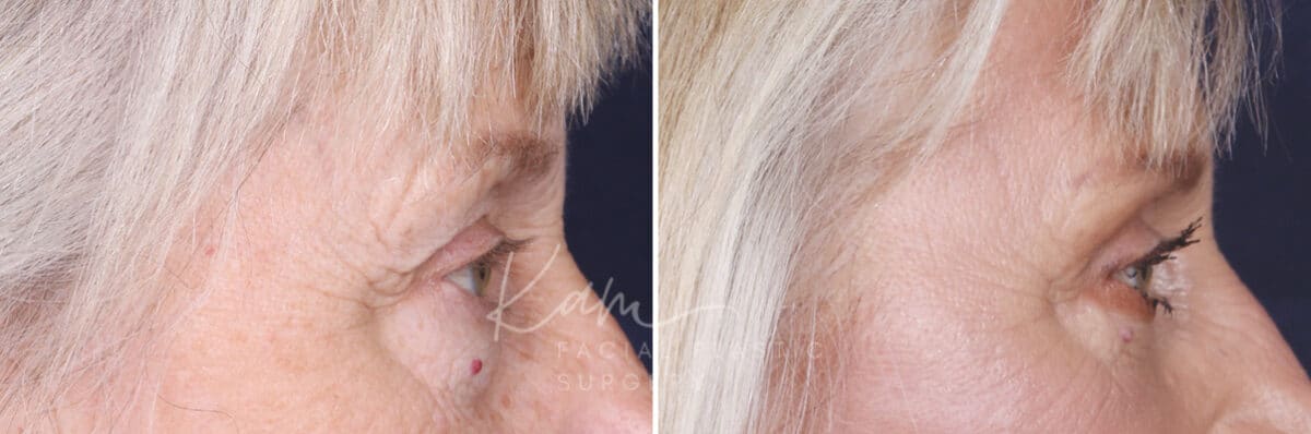 Lower Blepharoplasty before and after photos in Voorhees, NJ, Patient 520