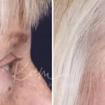 Lower Blepharoplasty before and after photos in Voorhees, NJ, Patient 520