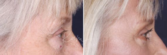 Lower Blepharoplasty before and after photos in Voorhees, NJ, Patient 520