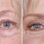 Lower Blepharoplasty before and after photos in Voorhees, NJ, Patient 520