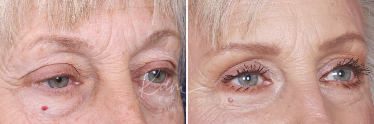 Lower Blepharoplasty before and after photos in Voorhees, NJ, Patient 520