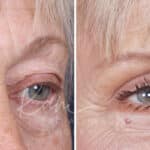 Lower Blepharoplasty before and after photos in Voorhees, NJ, Patient 520