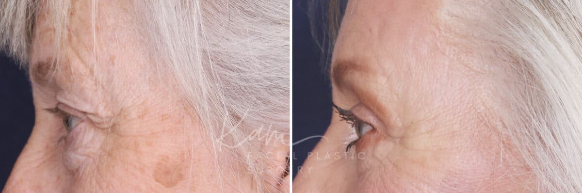 Lower Blepharoplasty before and after photos in Voorhees, NJ, Patient 520