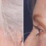 Lower Blepharoplasty before and after photos in Voorhees, NJ, Patient 520