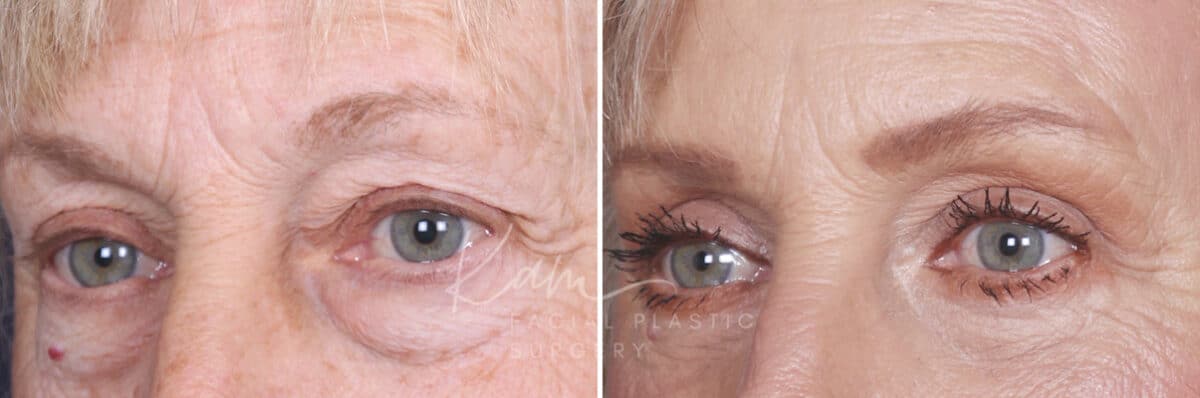 Lower Blepharoplasty before and after photos in Voorhees, NJ, Patient 520