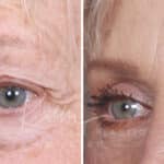 Lower Blepharoplasty before and after photos in Voorhees, NJ, Patient 520