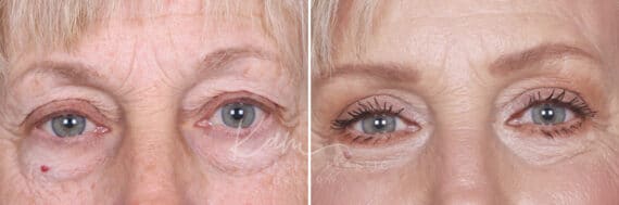 Lower Blepharoplasty before and after photos in Voorhees, NJ, Patient 520