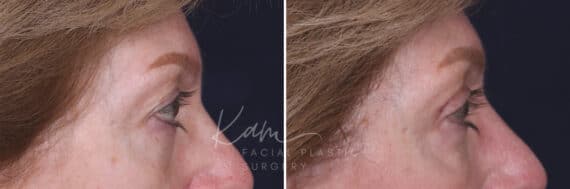 Upper Blepharoplasty before and after photos in Voorhees, NJ, Patient 551