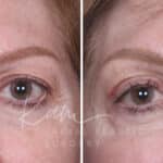Upper Blepharoplasty before and after photos in Voorhees, NJ, Patient 551