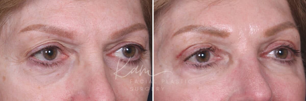 Upper Blepharoplasty before and after photos in Voorhees, NJ, Patient 551