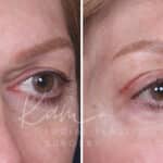 Upper Blepharoplasty before and after photos in Voorhees, NJ, Patient 551