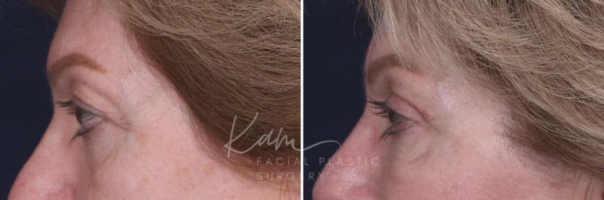 Upper Blepharoplasty before and after photos in Voorhees, NJ, Patient 551