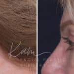 Upper Blepharoplasty before and after photos in Voorhees, NJ, Patient 551