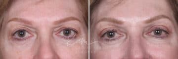 Upper Blepharoplasty before and after photos in Voorhees, NJ, Patient 551
