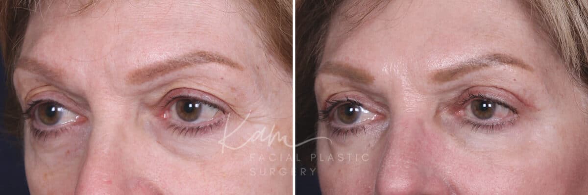 Upper Blepharoplasty before and after photos in Voorhees, NJ, Patient 551