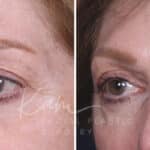 Upper Blepharoplasty before and after photos in Voorhees, NJ, Patient 551