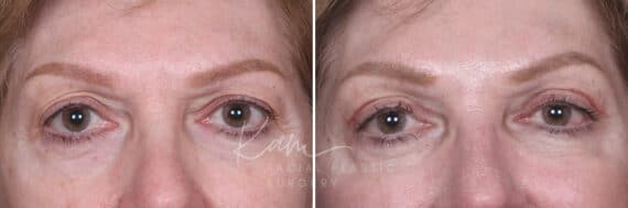 Upper Blepharoplasty before and after photos in Voorhees, NJ, Patient 551