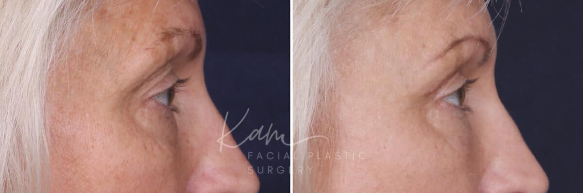 Upper Blepharoplasty before and after photos in Voorhees, NJ, Patient 568