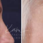 Upper Blepharoplasty before and after photos in Voorhees, NJ, Patient 568