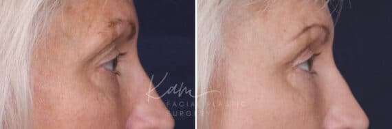 Upper Blepharoplasty before and after photos in Voorhees, NJ, Patient 568