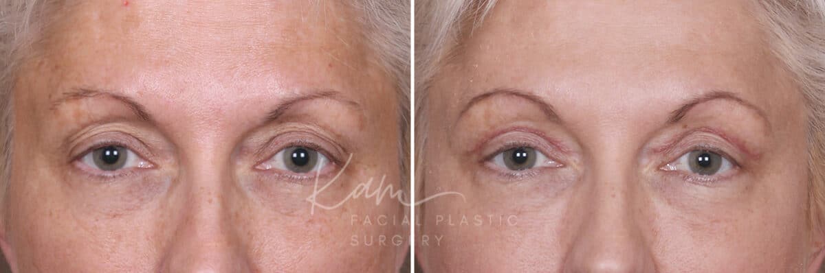 Upper Blepharoplasty before and after photos in Voorhees, NJ, Patient 568
