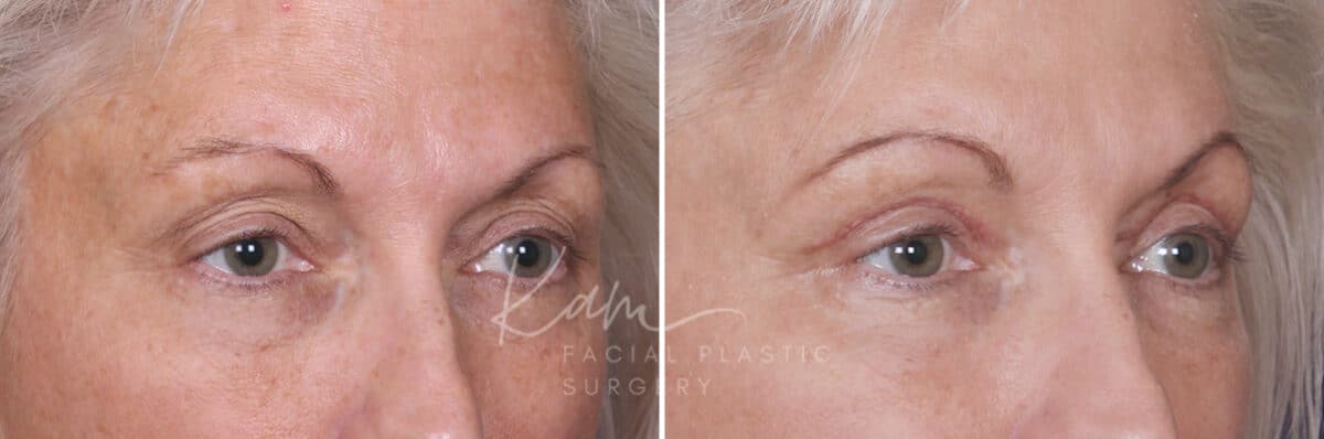 Upper Blepharoplasty before and after photos in Voorhees, NJ, Patient 568