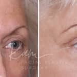 Upper Blepharoplasty before and after photos in Voorhees, NJ, Patient 568