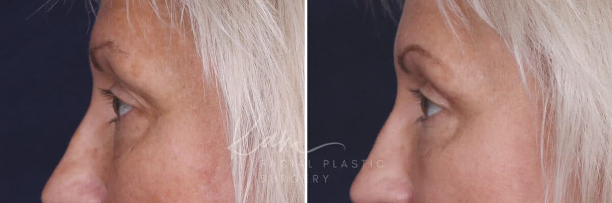 Upper Blepharoplasty before and after photos in Voorhees, NJ, Patient 568