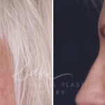 Upper Blepharoplasty before and after photos in Voorhees, NJ, Patient 568