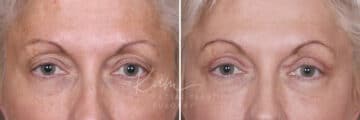 Upper Blepharoplasty before and after photos in Voorhees, NJ, Patient 568