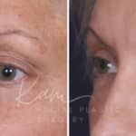 Upper Blepharoplasty before and after photos in Voorhees, NJ, Patient 568