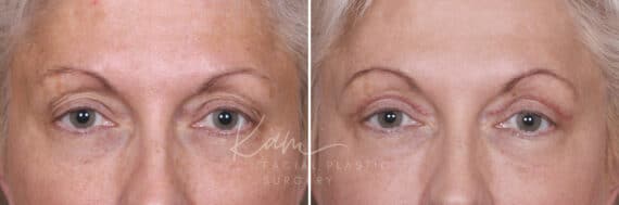 Upper Blepharoplasty before and after photos in Voorhees, NJ, Patient 568